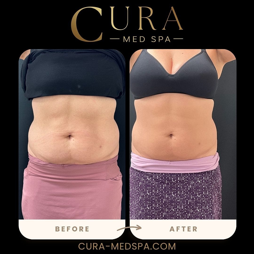 Body Sculpting (Weight Loss) Gallery Before & After