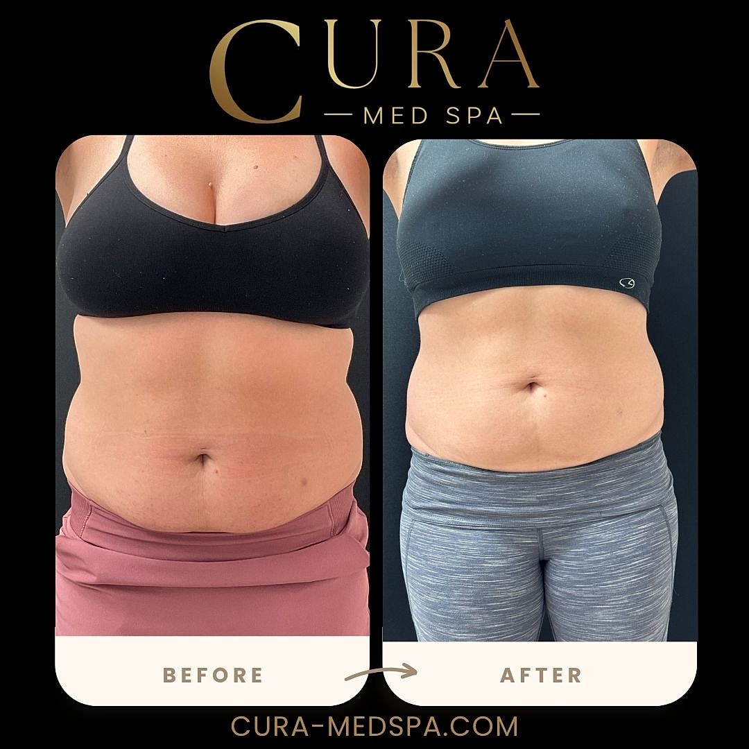 Body Sculpting (Weight Loss) Gallery Before & After