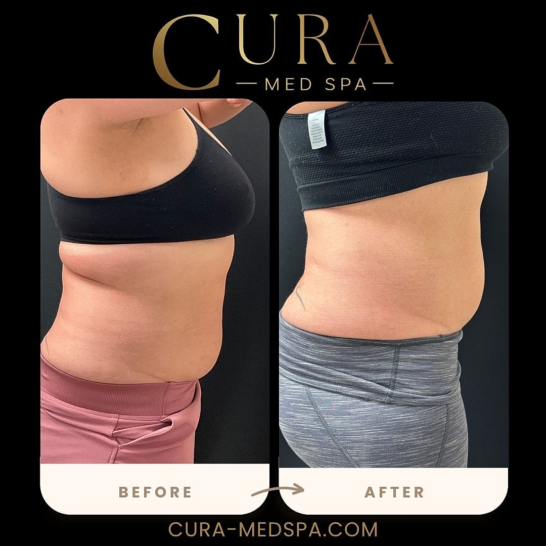 Body Sculpting (Weight Loss) Gallery Before & After