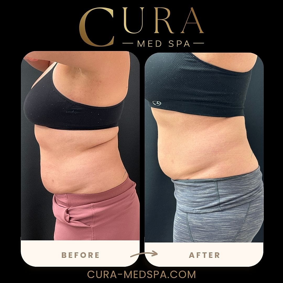 Body Sculpting (Weight Loss) Gallery Before & After