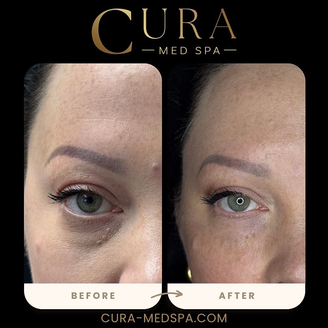 Regenerative Growth Factor Therapy (PDGF) Gallery Before & After