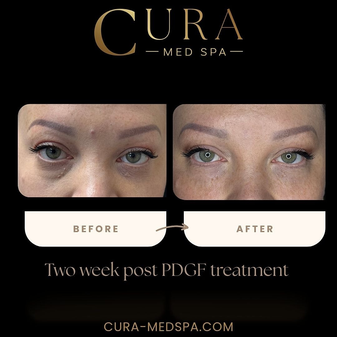 Regenerative Growth Factor Therapy (PDGF) Gallery Before & After