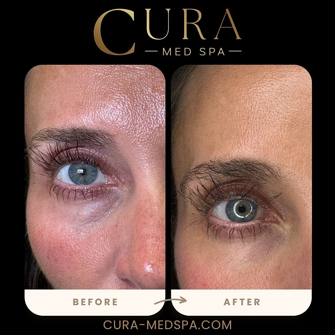 Regenerative Growth Factor Therapy (PDGF) Gallery Before & After