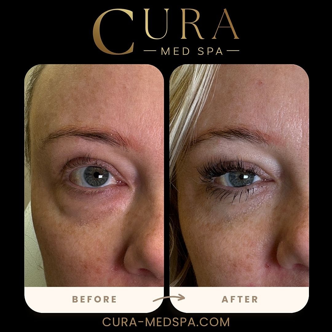 Regenerative Growth Factor Therapy (PDGF) Gallery Before & After
