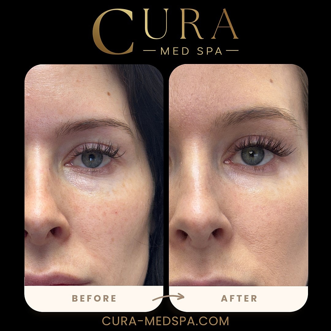 Regenerative Growth Factor Therapy (PDGF) Gallery Before & After