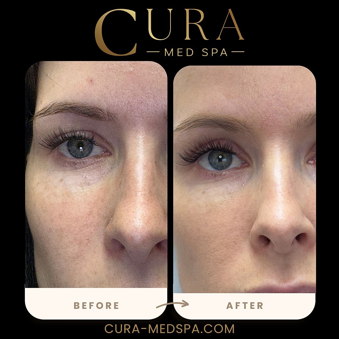 Regenerative Growth Factor Therapy (PDGF) Gallery Before & After