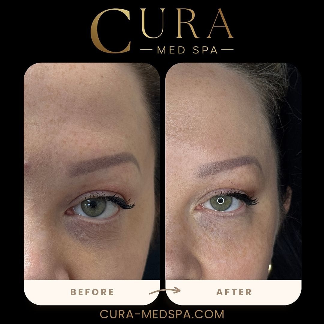 Regenerative Growth Factor Therapy (PDGF) Gallery Before & After