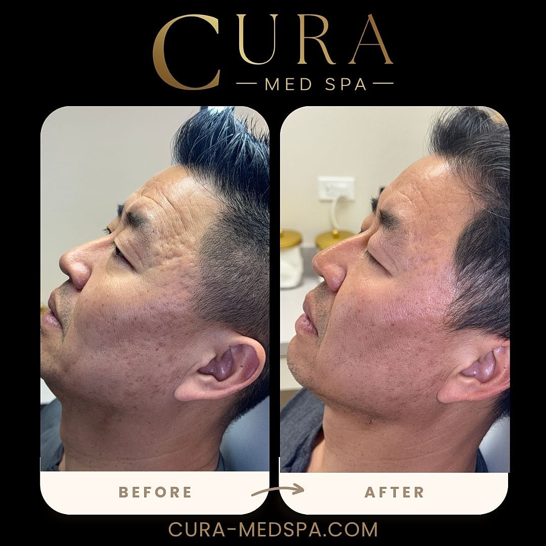Microneedling Gallery Before & After