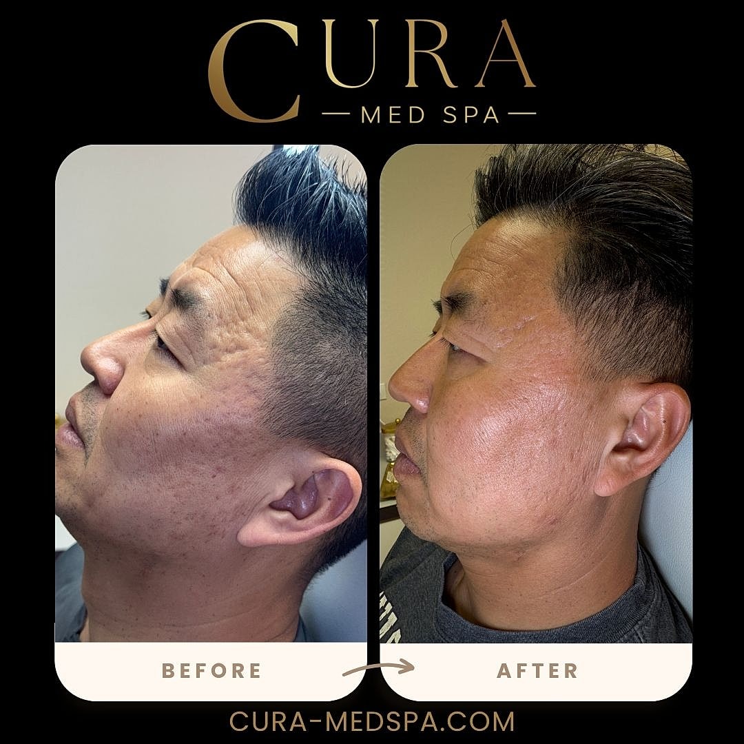 Microneedling Gallery Before & After