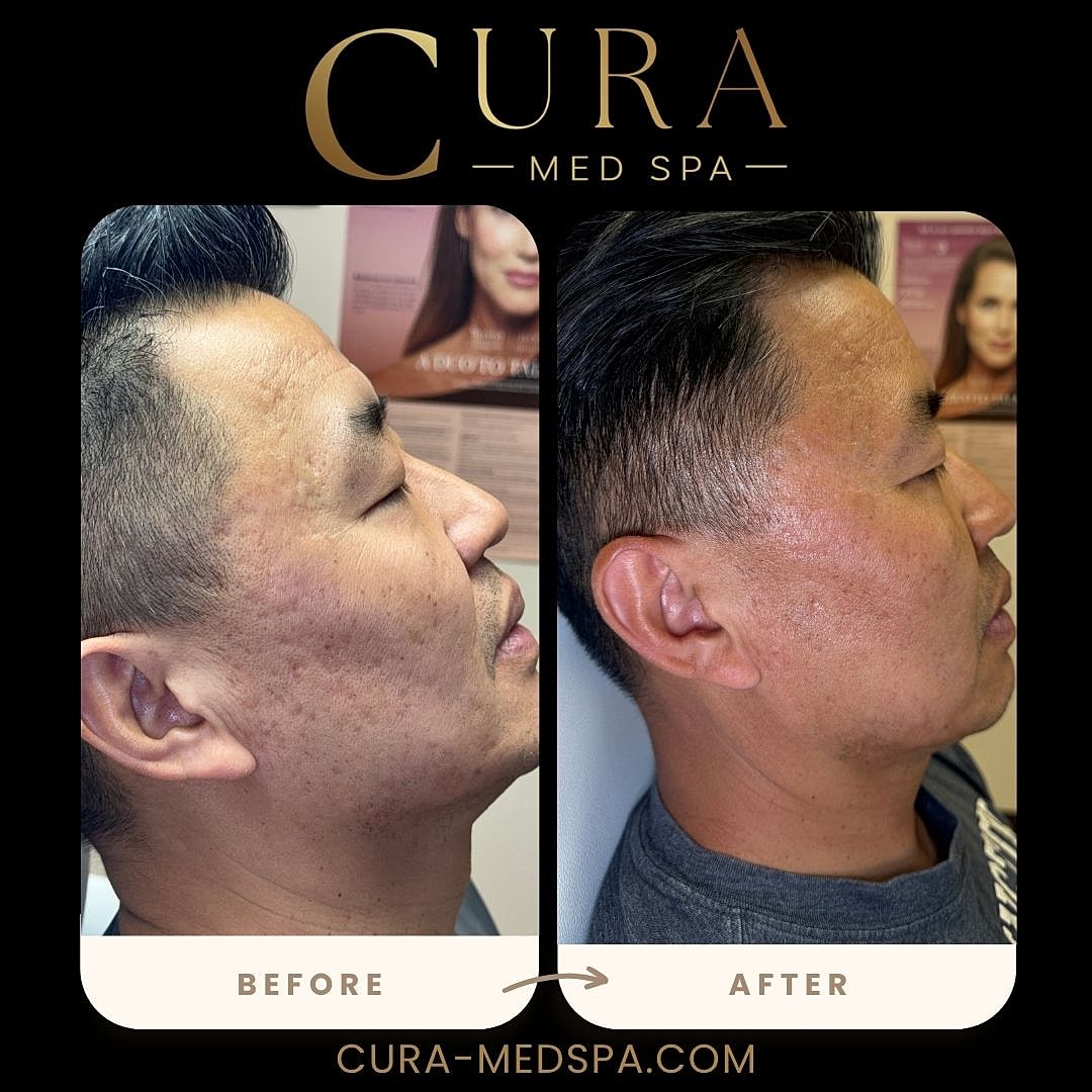 Microneedling Gallery Before & After