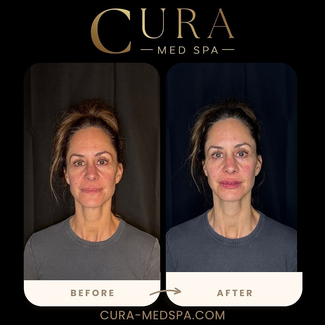 Lip Filler Gallery Before & After