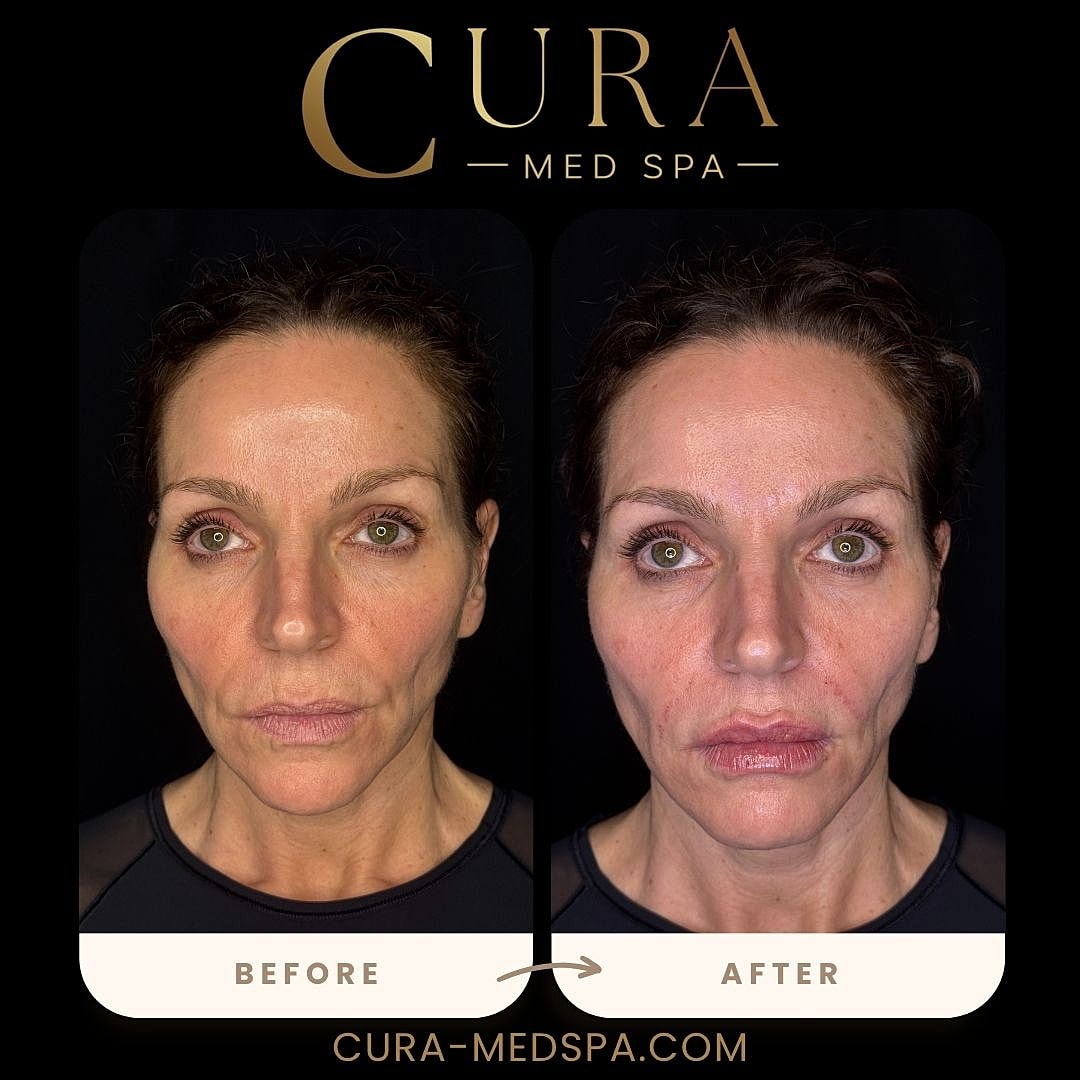Lip Filler Gallery Before & After