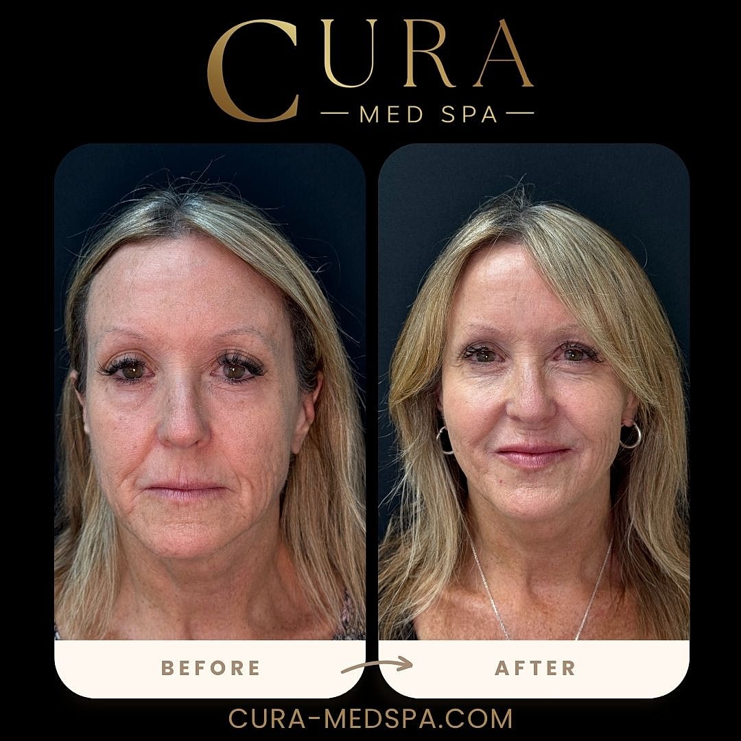 Lip Filler Gallery Before & After