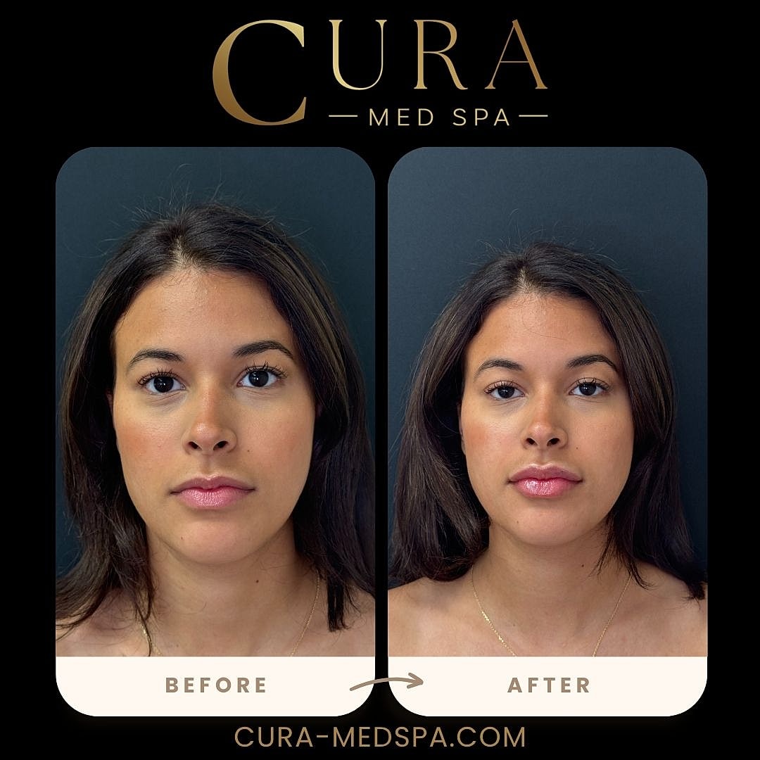 Lip Filler Gallery Before & After