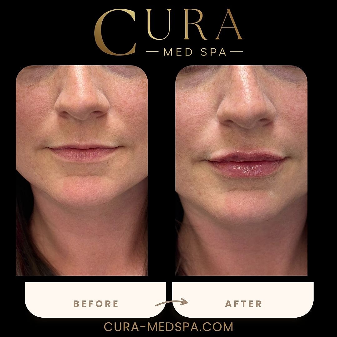 Lip Filler Gallery Before & After