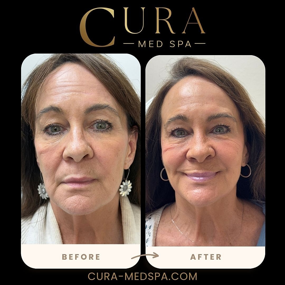Lip Filler Gallery Before & After