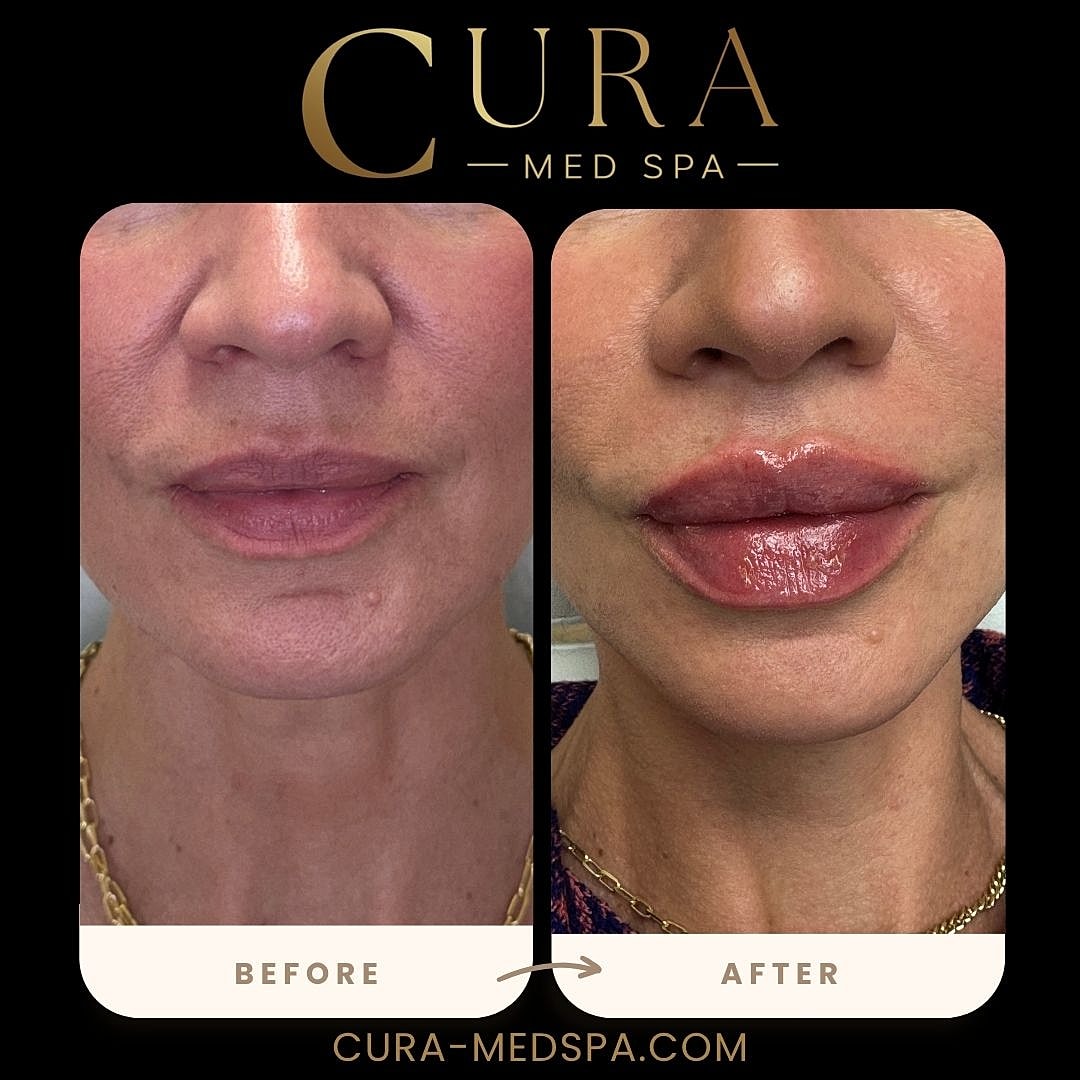 Lip Filler Gallery Before & After