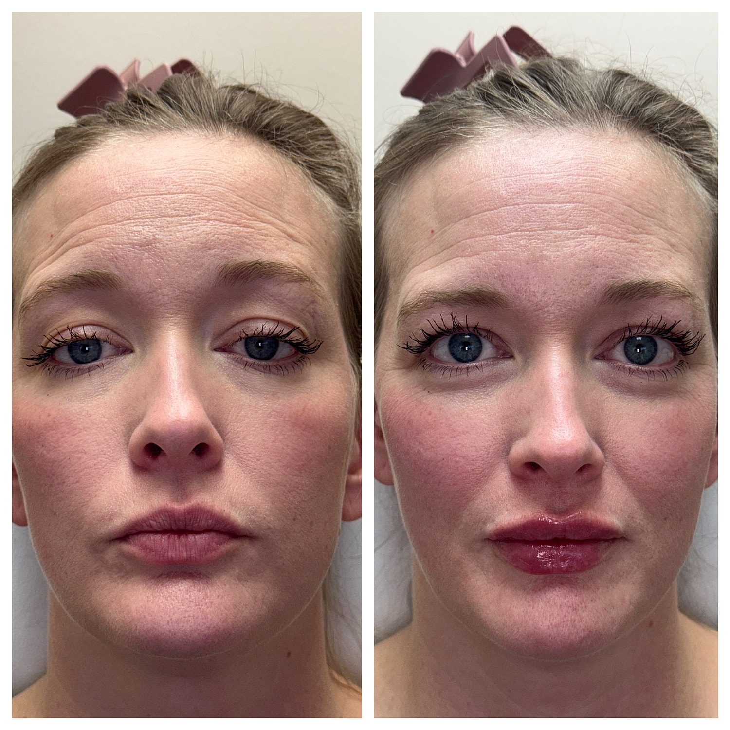 Lip Filler Gallery Before & After