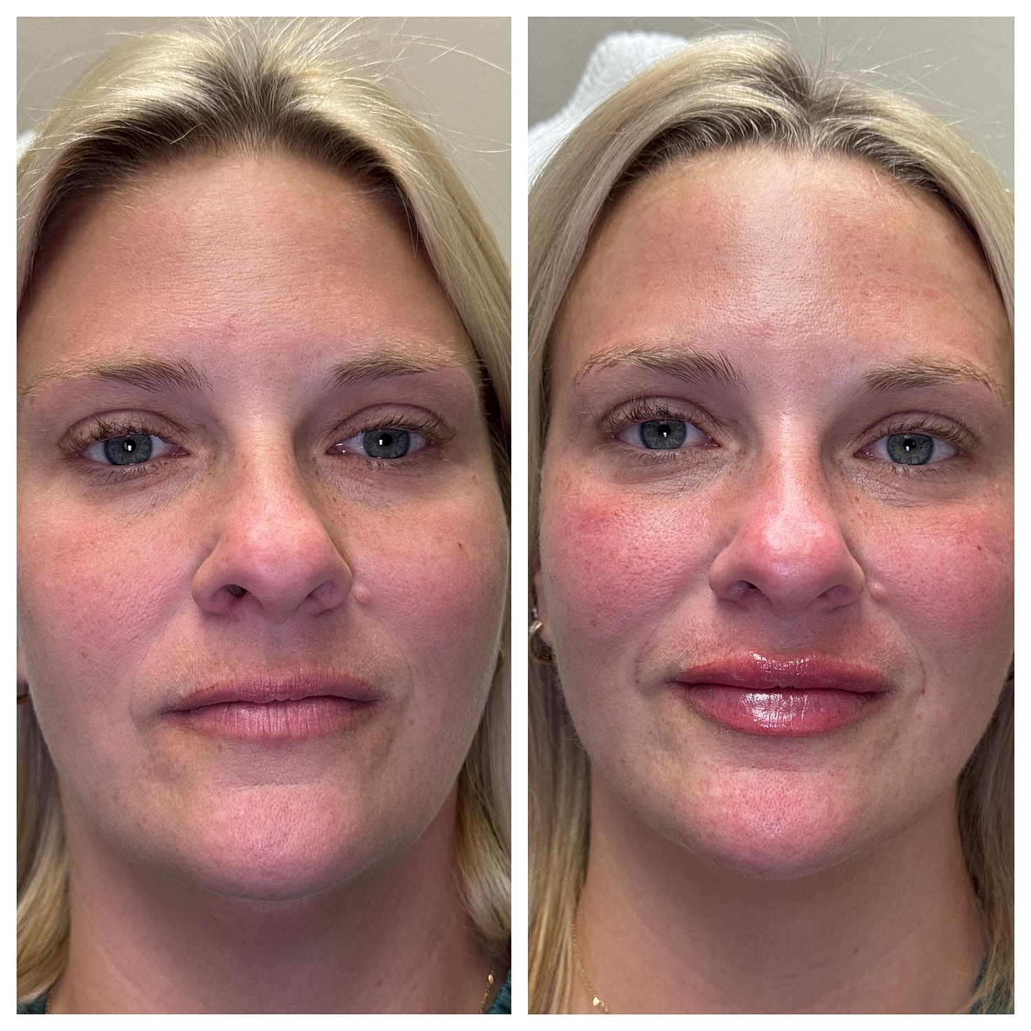 Lip Filler Gallery Before & After