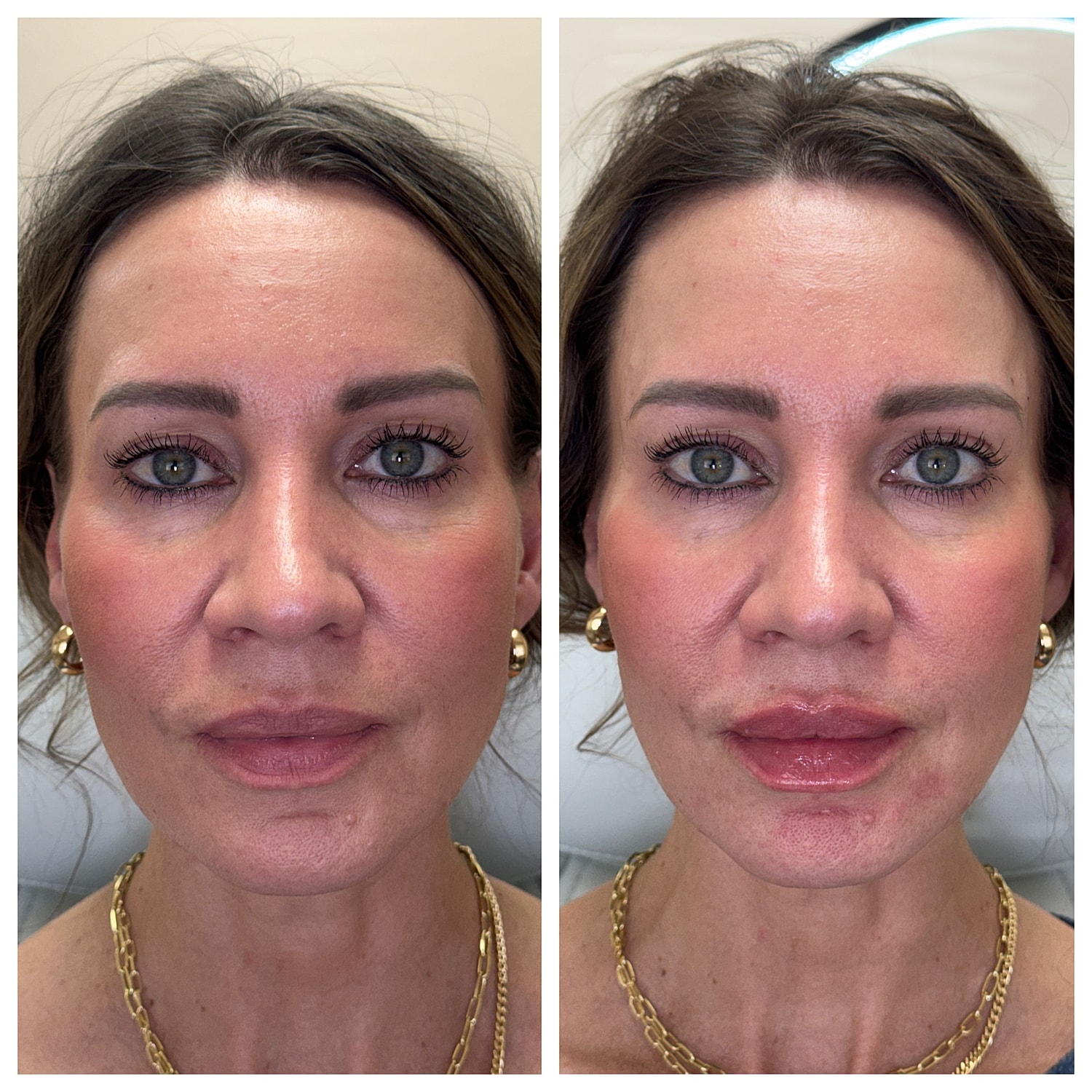 Lip Filler Gallery Before & After