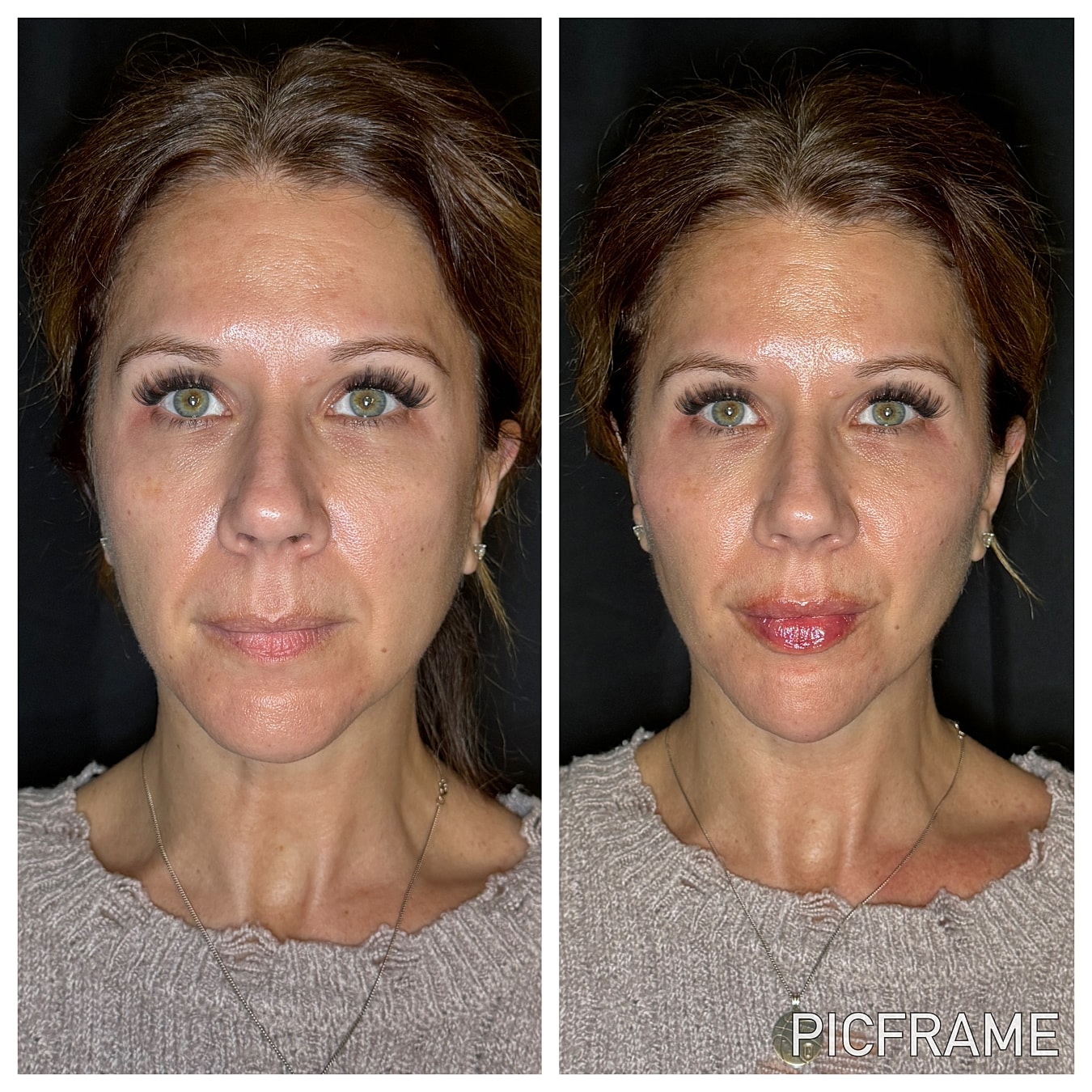 Lip Filler Gallery Before & After